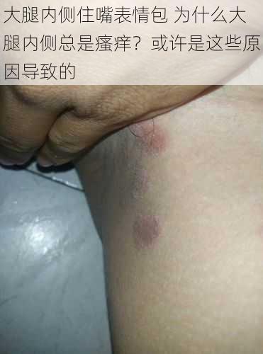 大腿内侧住嘴表情包 为什么大腿内侧总是瘙痒？或许是这些原因导致的